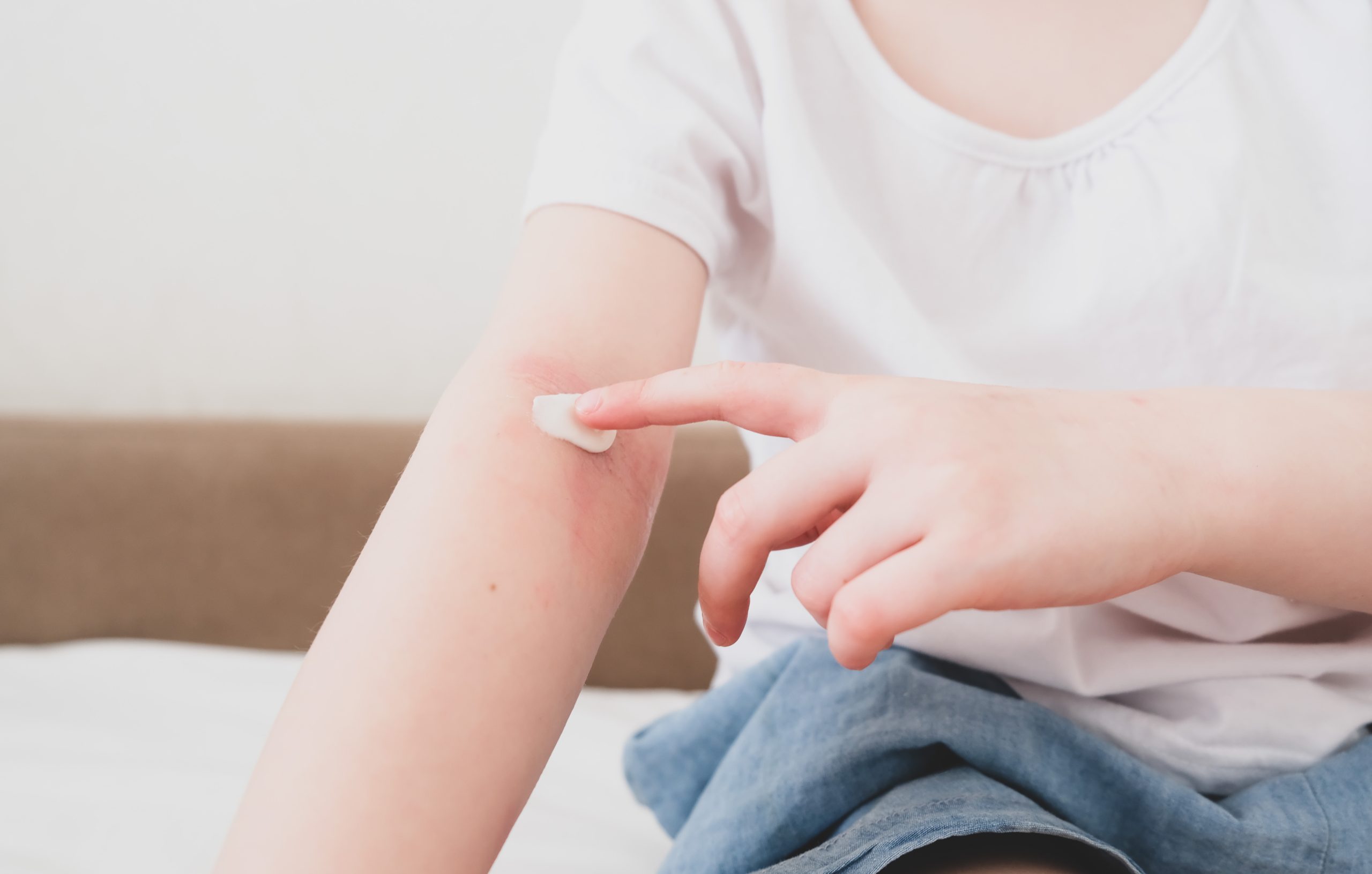 ダニはアレルギーの原因にも！